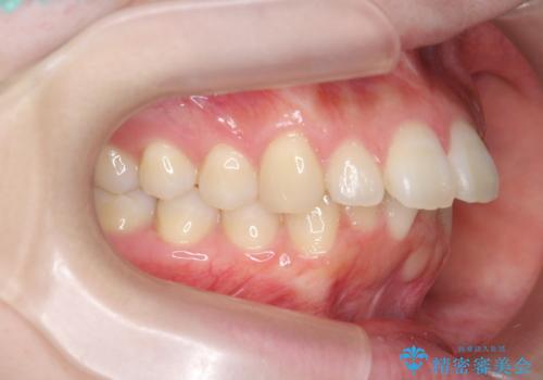 マウスピースで出っ歯感の改善の治療前
