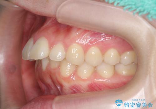 マウスピースで出っ歯感の改善の治療前