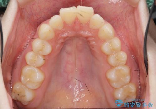 マウスピースで出っ歯感の改善の治療前