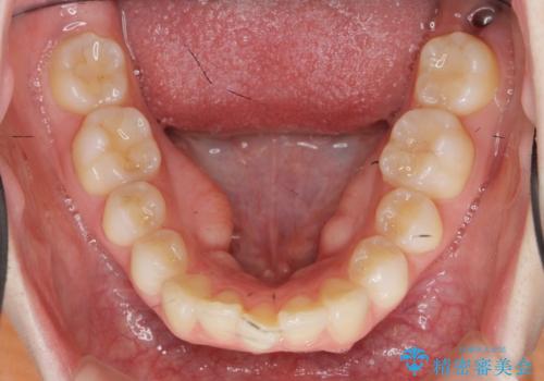 マウスピースで出っ歯感の改善の治療前