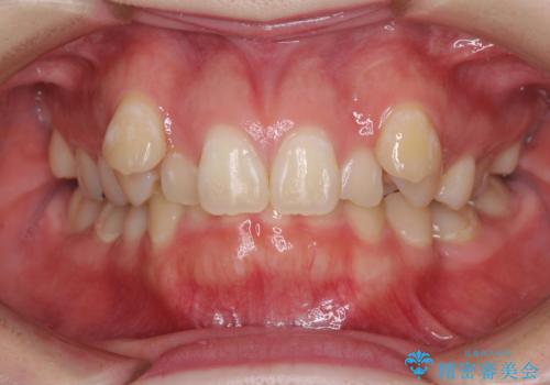 著しい八重歯を短期間で改善　ワイヤー装置による抜歯矯正の症例 治療前