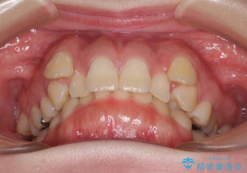 著しい八重歯を短期間で改善 ワイヤー装置による抜歯矯正の治療前