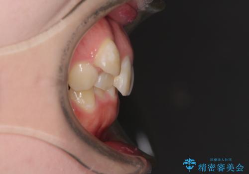 著しい八重歯を短期間で改善 ワイヤー装置による抜歯矯正の治療前