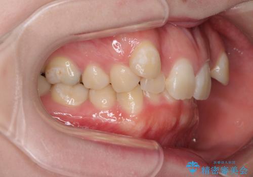 著しい八重歯を短期間で改善 ワイヤー装置による抜歯矯正の治療前