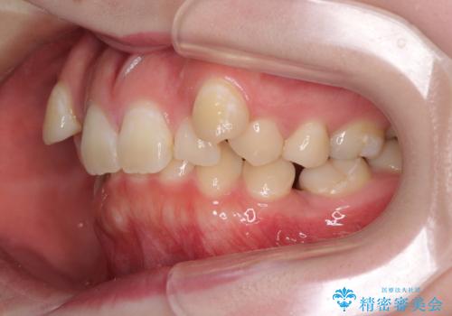 著しい八重歯を短期間で改善 ワイヤー装置による抜歯矯正の治療前