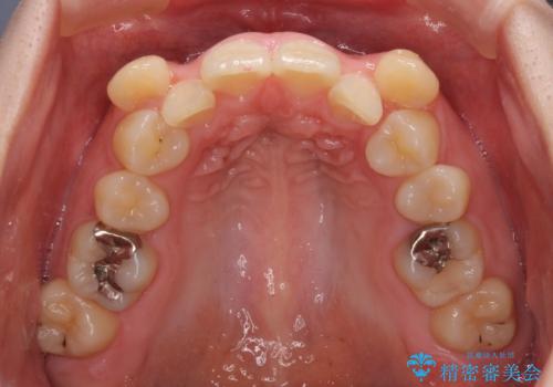 著しい八重歯を短期間で改善 ワイヤー装置による抜歯矯正の治療前