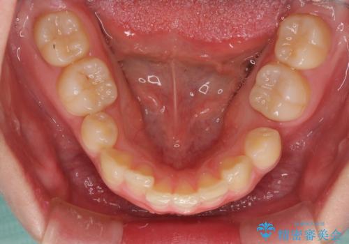著しい八重歯を短期間で改善 ワイヤー装置による抜歯矯正の治療前