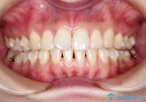 その前歯の捻じれ、原因は奥歯の噛み合わせのズレにあります。の治療中