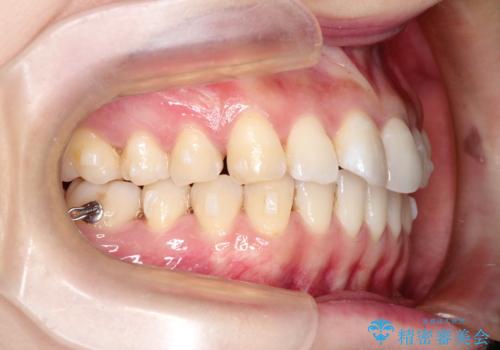 その前歯の捻じれ、原因は奥歯の噛み合わせのズレにあります。の治療中