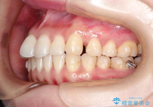 その前歯の捻じれ、原因は奥歯の噛み合わせのズレにあります。の治療中