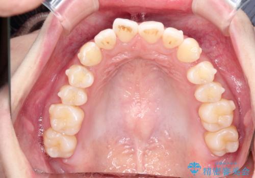 その前歯の捻じれ、原因は奥歯の噛み合わせのズレにあります。の治療中