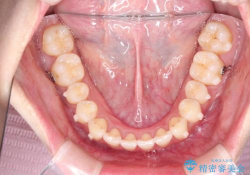 その前歯の捻じれ、原因は奥歯の噛み合わせのズレにあります。の治療中