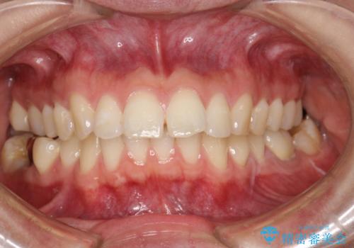出っ歯の矯正　抜歯をしてしっかり引っ込めるワイヤー矯正の治療前