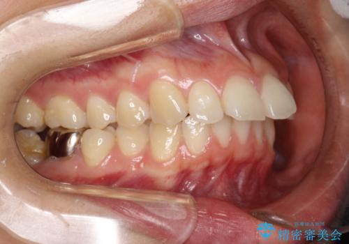 出っ歯の矯正 抜歯をしてしっかり引っ込めるワイヤー矯正の治療前