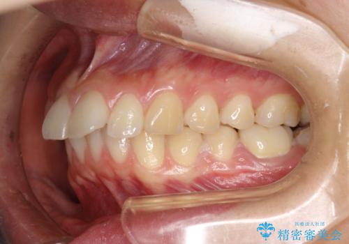 出っ歯の矯正　抜歯をしてしっかり引っ込めるワイヤー矯正の症例 治療前