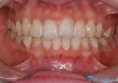 前歯の重なりは奥歯のズレが原因:まとめてインビザラインで治すの症例 治療前