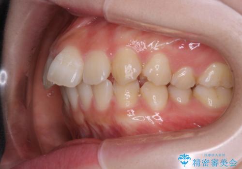 前歯の重なりは奥歯のズレが原因:まとめてインビザラインで治すの治療前