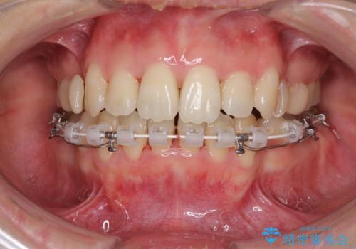 Eラインを改善したい ハーフリンガルによる抜歯矯正の治療中