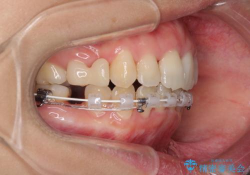 Eラインを改善したい ハーフリンガルによる抜歯矯正の治療中