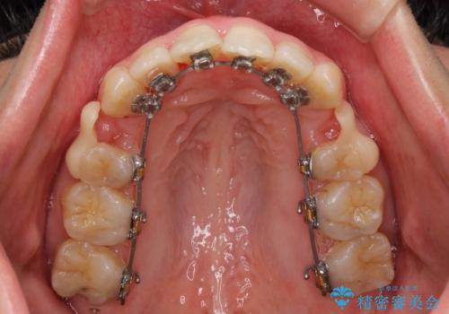 Eラインを改善したい ハーフリンガルによる抜歯矯正の治療中