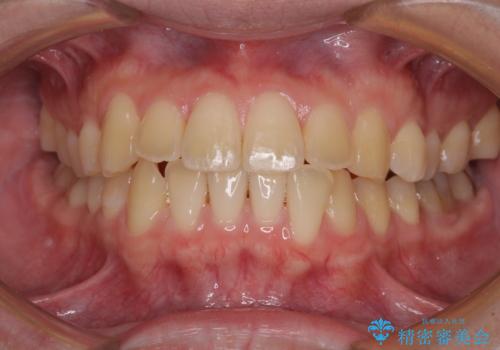 【モニター】前歯のクロスバイトと隙間を改善 インビザラインによる矯正治療の治療中