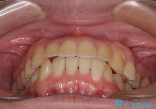 【モニター】前歯のクロスバイトと隙間を改善 インビザラインによる矯正治療の治療中