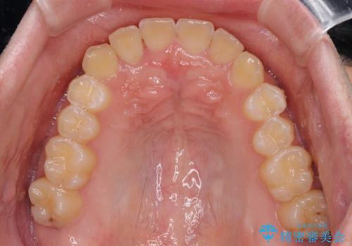 【モニター】前歯のクロスバイトと隙間を改善　インビザラインによる矯正治療の治療中