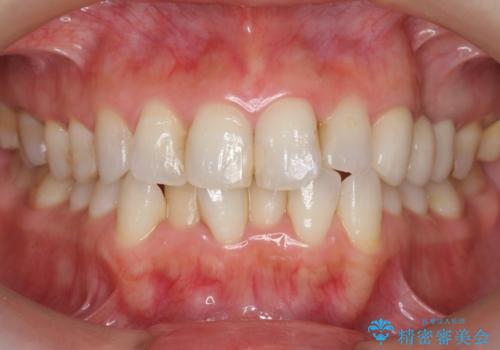 つぎはぎの前歯をセラミックにしたいの治療前