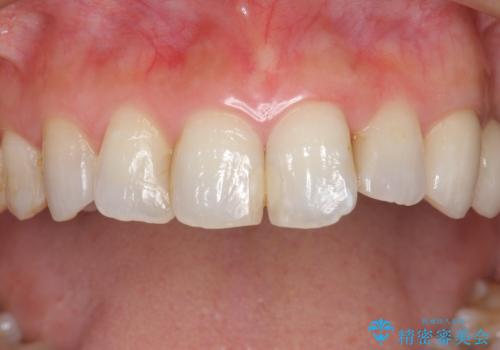 つぎはぎの前歯をセラミックにしたいの症例 治療前