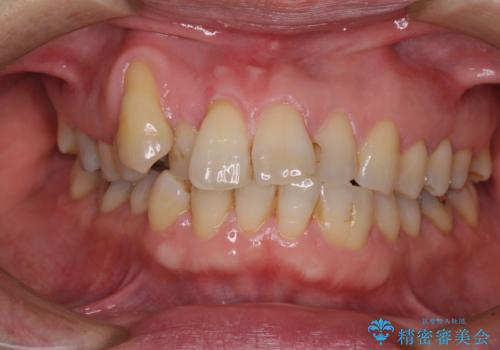 八重歯と形の悪い前歯　矯正治療とセラミック治療の症例 治療前