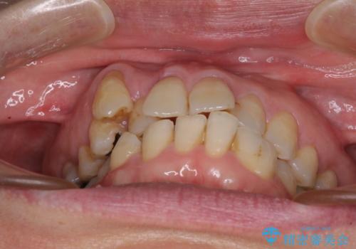 八重歯と形の悪い前歯　矯正治療とセラミック治療の治療前