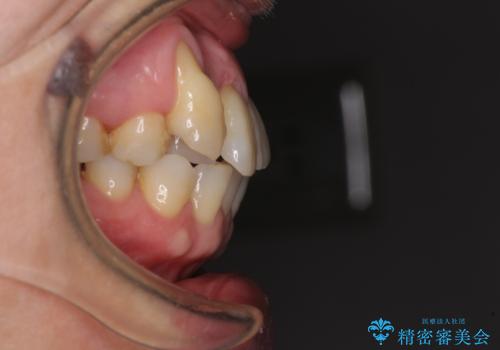 八重歯と形の悪い前歯　矯正治療とセラミック治療の治療前