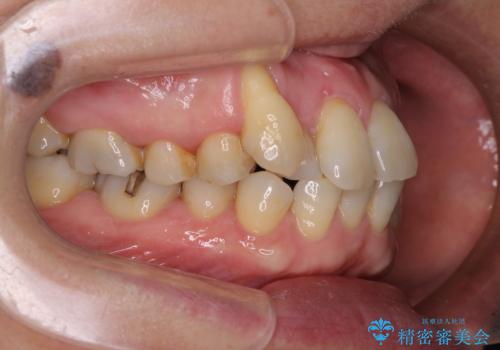 八重歯と形の悪い前歯 矯正治療とセラミック治療の治療前