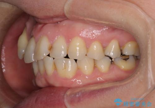 八重歯と形の悪い前歯 矯正治療とセラミック治療の治療前