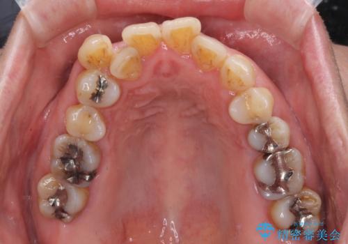 八重歯と形の悪い前歯 矯正治療とセラミック治療の治療前