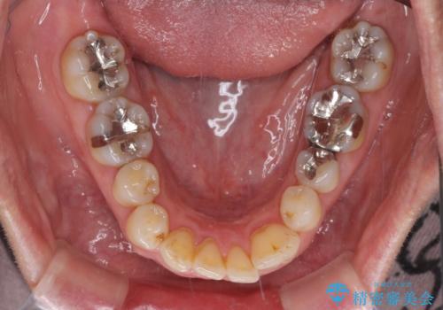 八重歯と形の悪い前歯 矯正治療とセラミック治療の治療前