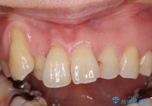 八重歯と形の悪い前歯 矯正治療とセラミック治療の治療前