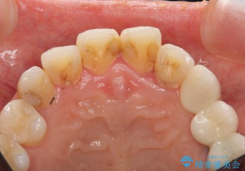 つぎはぎの前歯をセラミックにしたいの治療前