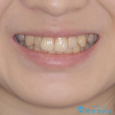 デコボコ歯列をきれいに　インビザラインによる矯正治療の治療前（顔貌）
