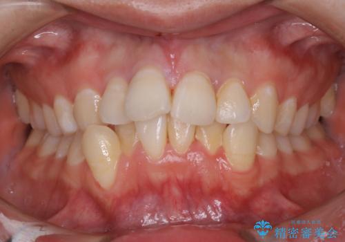 定期的にクリーニングを(PMTC)の治療前