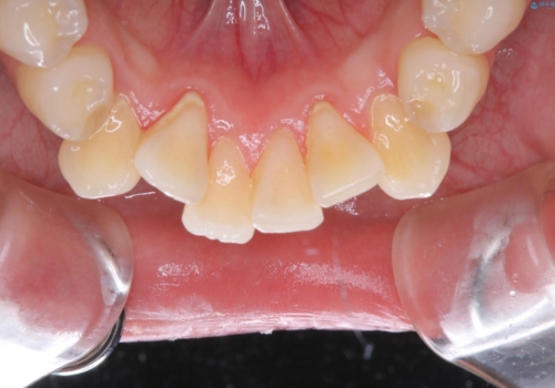 定期的にクリーニングを(PMTC)の治療前