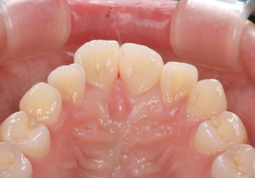 定期的にクリーニングを(PMTC)の治療前