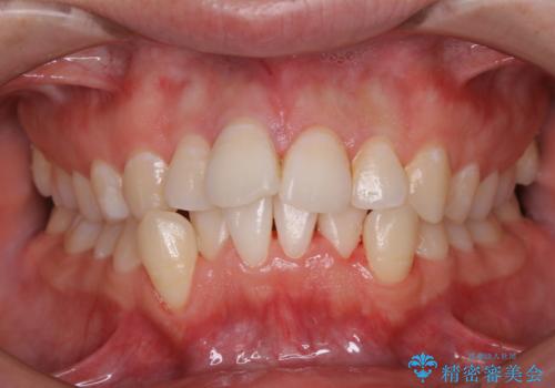定期的にクリーニングを(PMTC)の治療後