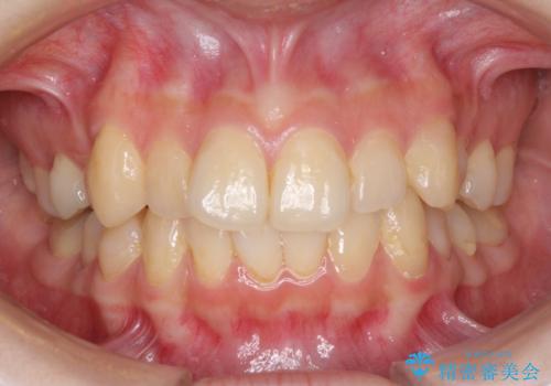 デコボコ歯列をきれいに インビザラインによる矯正治療の症例 治療前