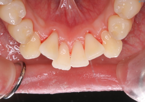 定期的にクリーニングを(PMTC)の治療後