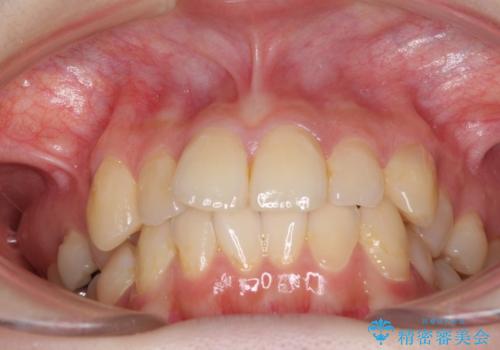 デコボコ歯列をきれいに インビザラインによる矯正治療の治療前
