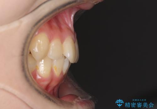 デコボコ歯列をきれいに インビザラインによる矯正治療の治療前