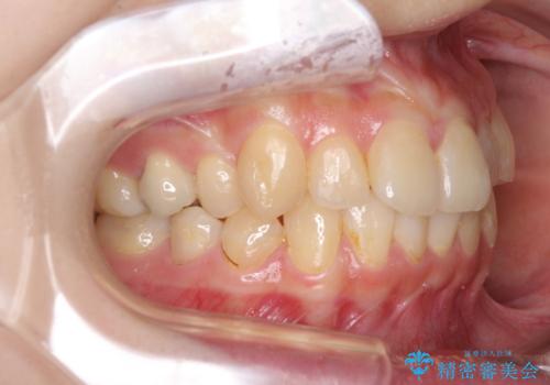 デコボコ歯列をきれいに インビザラインによる矯正治療の治療前