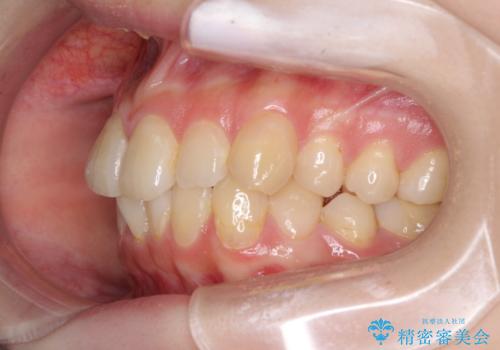 デコボコ歯列をきれいに　インビザラインによる矯正治療の治療前