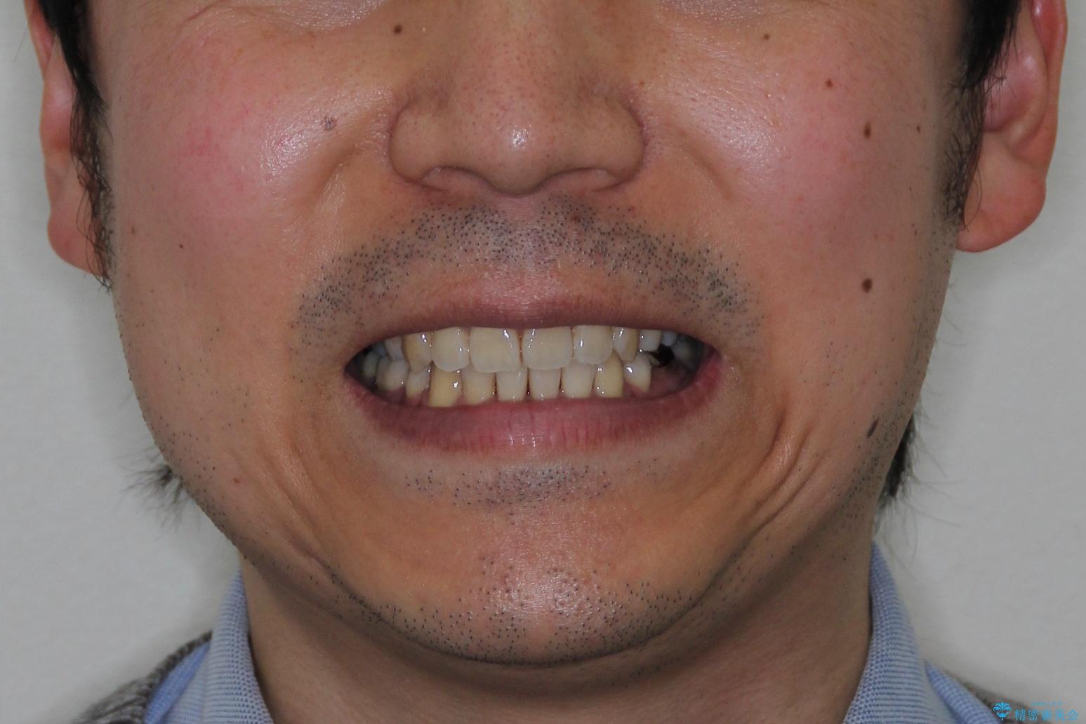飛び出た八重歯!コンプレックスを払拭!の治療後(顔貌)